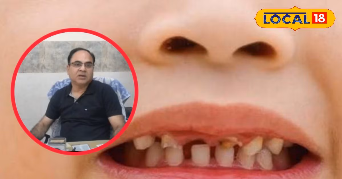 बच्चों में तेजी से बढ़ रही दांतों की सड़न, यहां डॉक्टर से जानिए कारण और बचाव के देसी तरीके