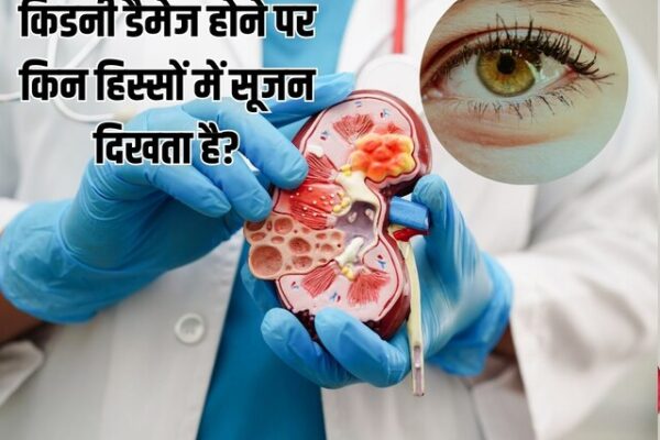 Kidney Damage Sign: चुपचाप सड़ रही किडनी, शरीर के इन 4 हिस्सों में सूजन रेड फ्लैग, आप तो नहीं कर रहे इग्नोर