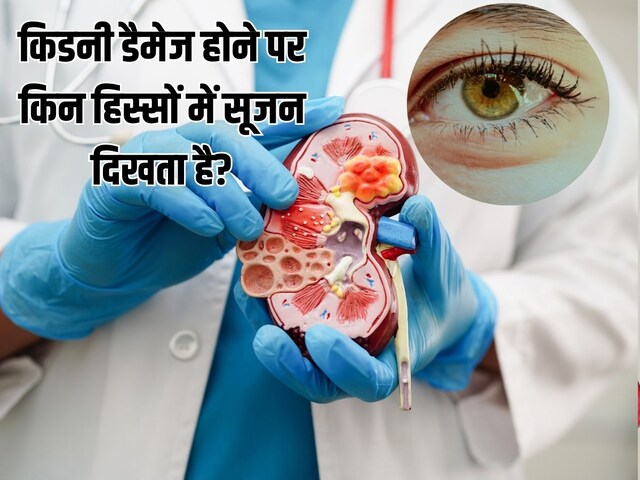 Kidney Damage Sign: चुपचाप सड़ रही किडनी, शरीर के इन 4 हिस्सों में सूजन रेड फ्लैग, आप तो नहीं कर रहे इग्नोर