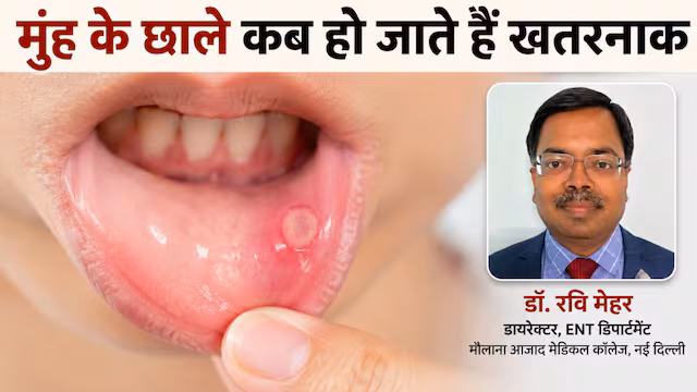 मुंह के छाले कब ले लेता है कैंसर का रूप, कैसे समझें कि ये नॉर्मल नहीं, ENT के बड़े डॉक्टर ने बताया क्लू