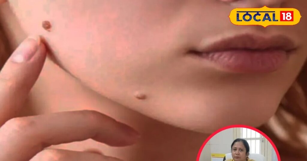 मस्सों की समस्या से हैं परेशान? होम्योपैथिक डॉक्टर ने बताए बचाव के साथ घरेलू इलाज