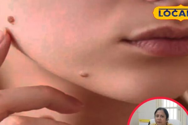 मस्सों की समस्या से हैं परेशान? होम्योपैथिक डॉक्टर ने बताए बचाव के साथ घरेलू इलाज