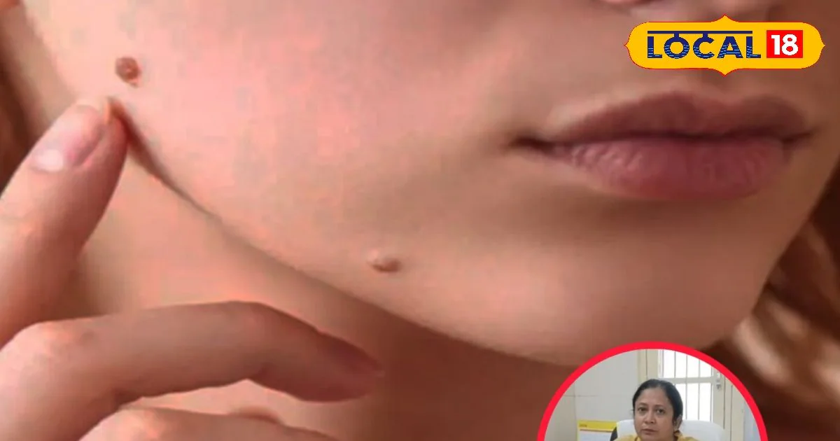 मस्सों की समस्या से हैं परेशान? होम्योपैथिक डॉक्टर ने बताए बचाव के साथ घरेलू इलाज