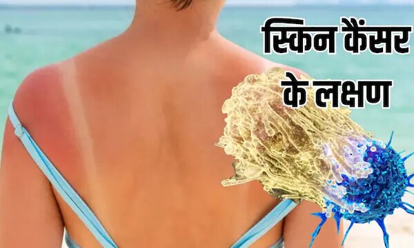 बार-बार हो रही टैनिंग? डॉ. की चेतावनी हो सकता है स्किन कैंसर का शुरुआती लक्षण