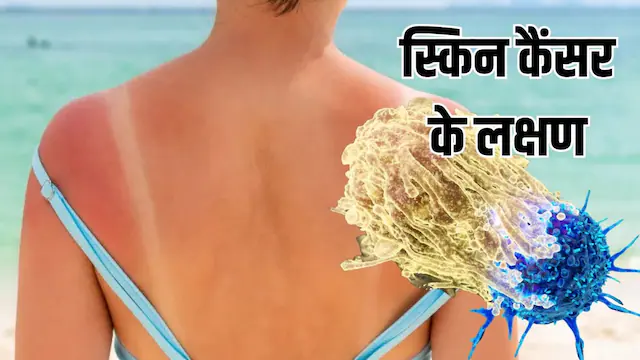 बार-बार हो रही टैनिंग? डॉ. की चेतावनी हो सकता है स्किन कैंसर का शुरुआती लक्षण