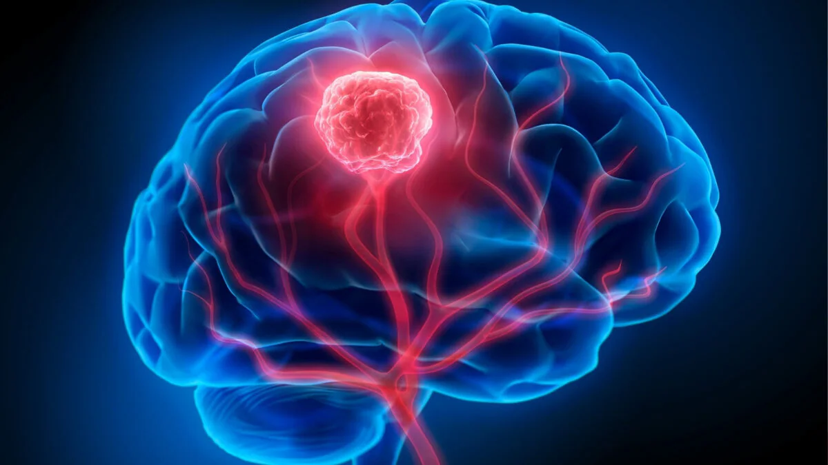 ब्रेन में ट्यूमर का मतलब कैंसर? न्यूरोलॉजिस्ट से जानें बच्चों में ब्रेन ट्यूमर के लक्षण, क्या है इसका मतलब
