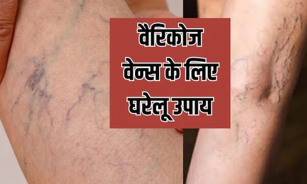 पैरों में जाल की तरह दिख रही नसें, जानें क्या है वैरिकाज वेन्स? घर पर इलाज का तरीका