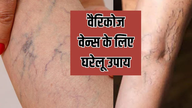 पैरों में जाल की तरह दिख रही नसें, जानें क्या है वैरिकाज वेन्स? घर पर इलाज का तरीका